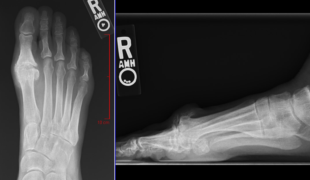 Big Toe Arthritis - Paul H. Kim, MD
